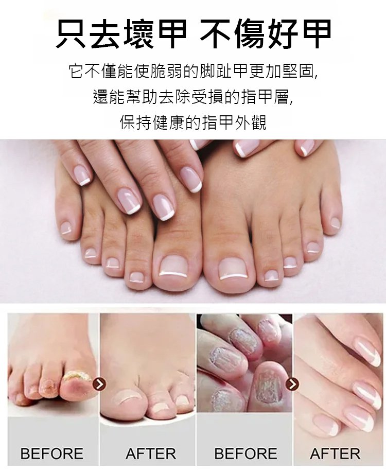 康速達灰指甲醫用退熱凝膠,,一個月手足灰甲全搞定,康束達凝膠5g每盒現貨速發 19 eed8070c4e801ffc4d842b2bdd7b7577 康速達灰指甲醫用退熱凝膠