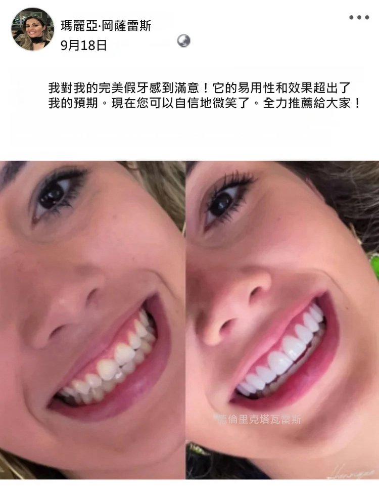 矽膠假牙套