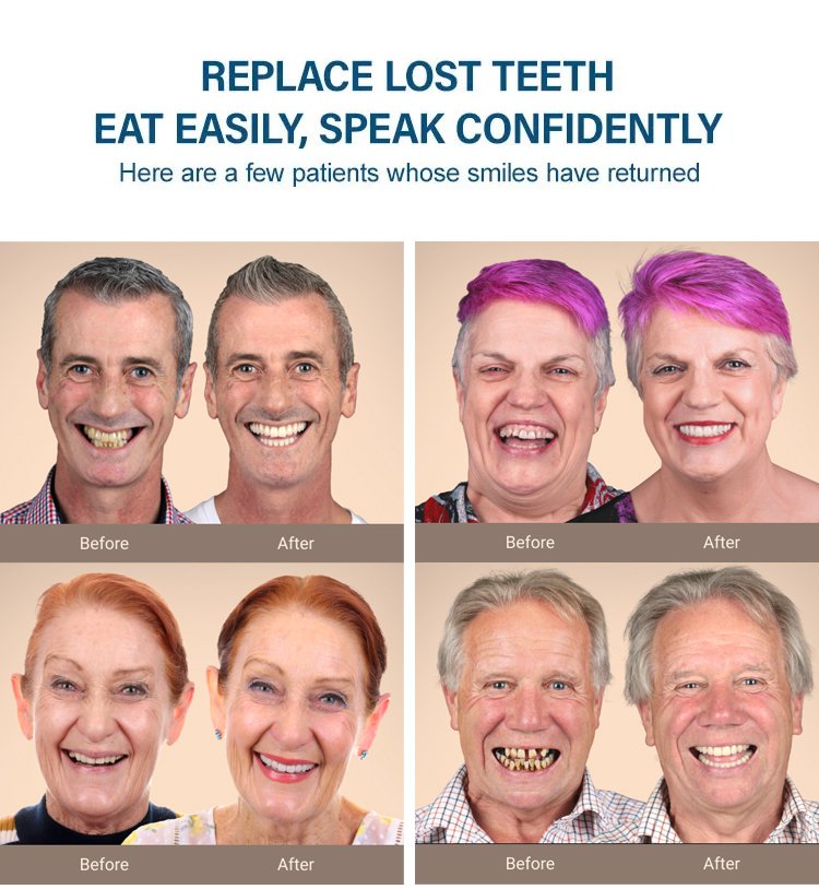 bd2f390c5a1f7a9513274da59d746881 MOON SMAIL Cosmetic dentures