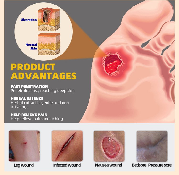 LOVILDS™Diabetic Wound Treatment Cream