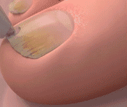 康速達灰指甲醫用退熱凝膠,,一個月手足灰甲全搞定,康束達凝膠5g每盒現貨速發 18 0ad3726d3e66641e89e772f481daae79 康速達灰指甲醫用退熱凝膠