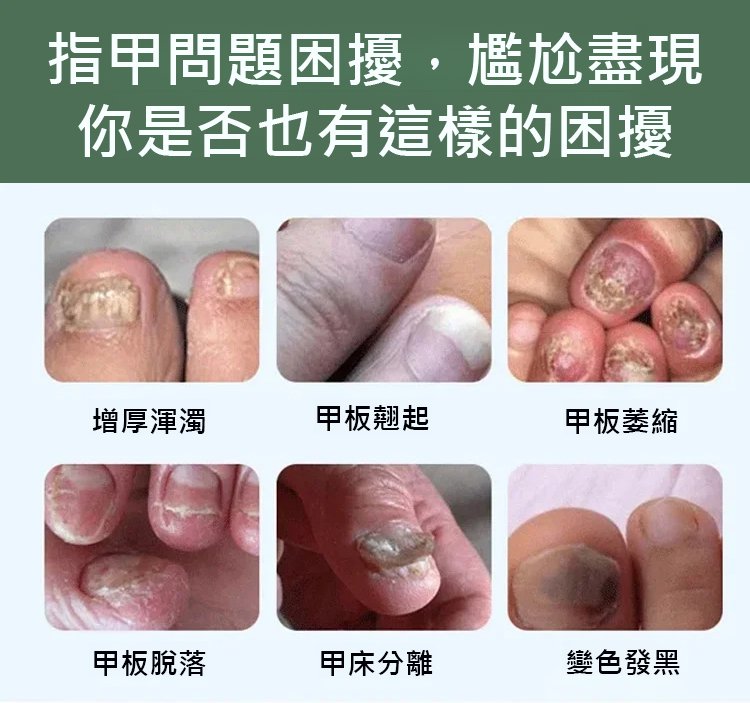 康速達灰指甲醫用退熱凝膠,,一個月手足灰甲全搞定,康束達凝膠5g每盒現貨速發 8 21332a955e9e262dada7388ede4db00b 康速達灰指甲醫用退熱凝膠