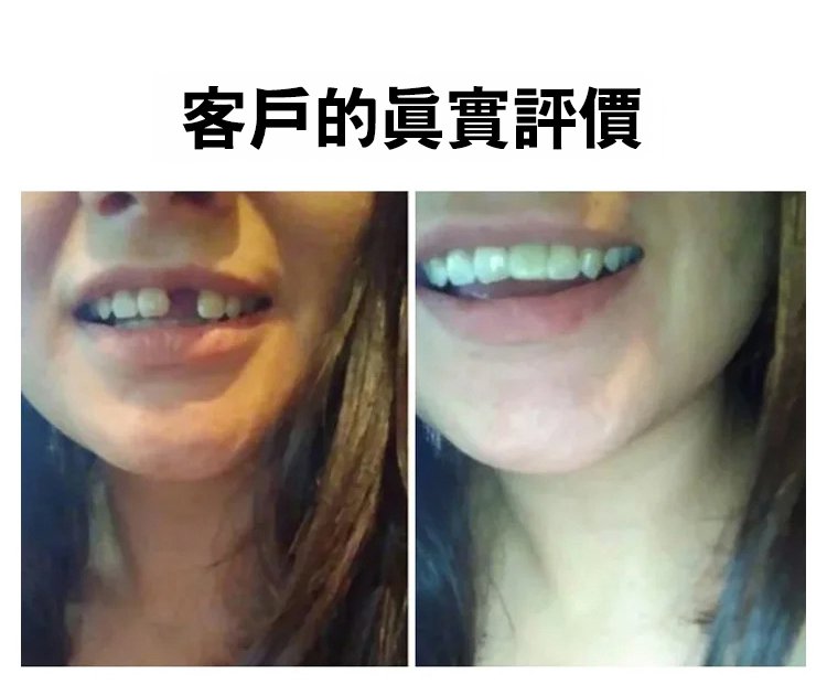 矽膠假牙套