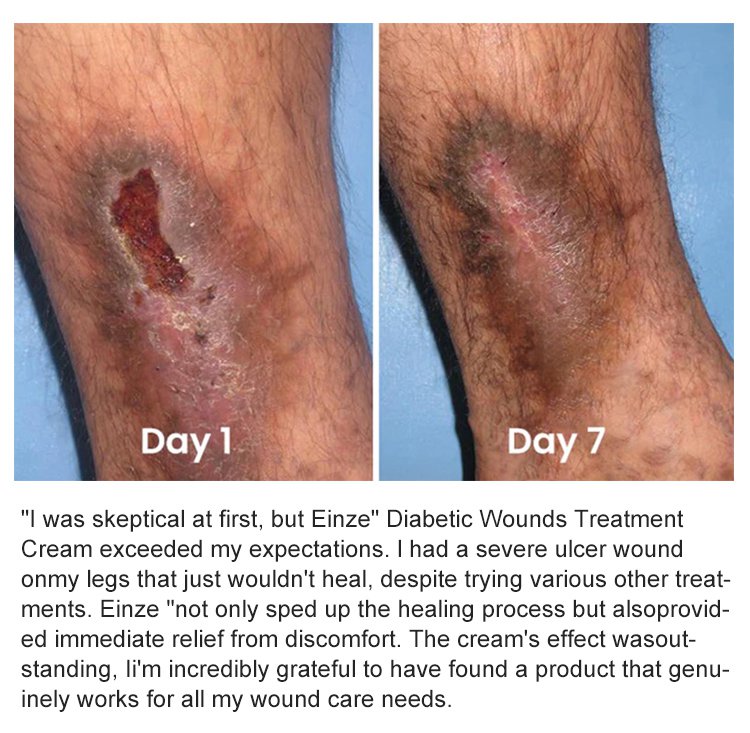 LOVILDS™Diabetic Wound Treatment Cream