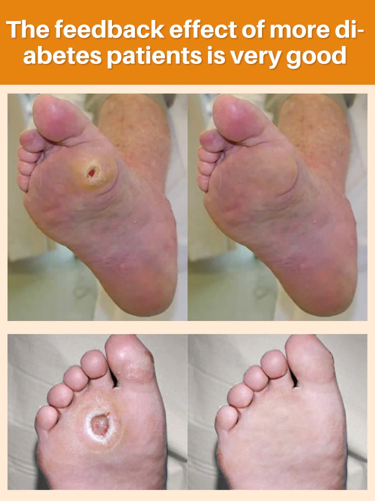 LOVILDS™Diabetic Wound Treatment Cream