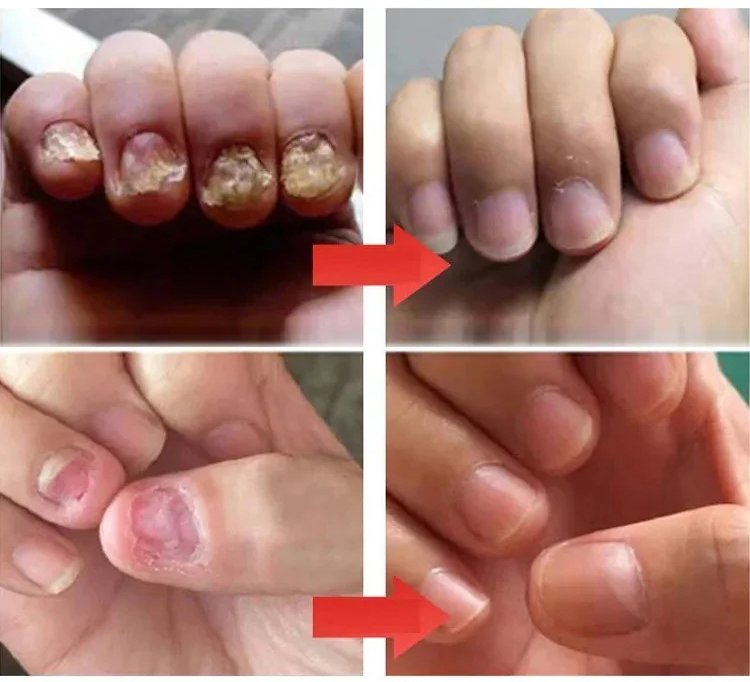 康速達灰指甲醫用退熱凝膠,,一個月手足灰甲全搞定,康束達凝膠5g每盒現貨速發 24 87464eb71607a3e7a43e2990186cb3b6 康速達灰指甲醫用退熱凝膠