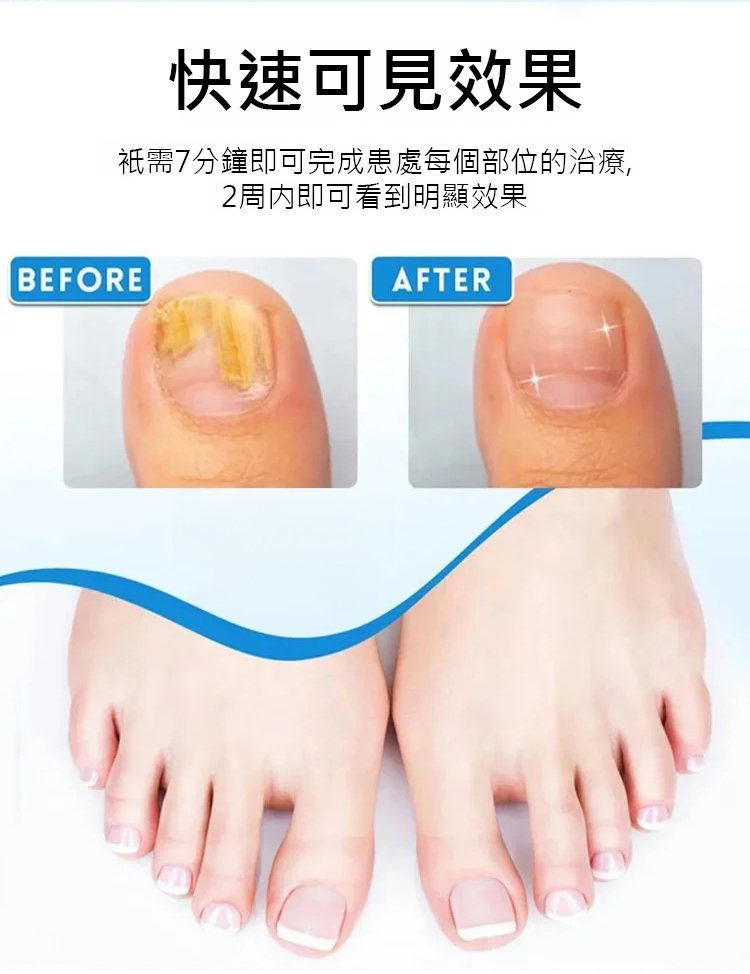 康速達灰指甲醫用退熱凝膠,,一個月手足灰甲全搞定,康束達凝膠5g每盒現貨速發 23 ba7f1aec4a52741bf3f7eda5e407e626 康速達灰指甲醫用退熱凝膠