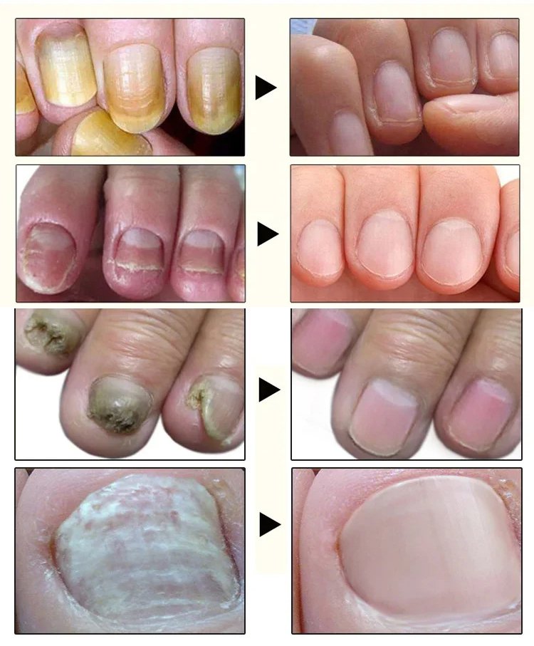 康速達灰指甲醫用退熱凝膠,,一個月手足灰甲全搞定,康束達凝膠5g每盒現貨速發 25 c7b61036e4efe92b042d832e35be3792 康速達灰指甲醫用退熱凝膠