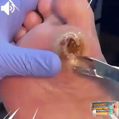 LOVILDS™Diabetic Wound Treatment Cream