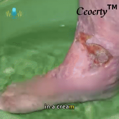 LOVILDS™Diabetic Wound Treatment Cream