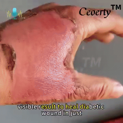 LOVILDS™Diabetic Wound Treatment Cream