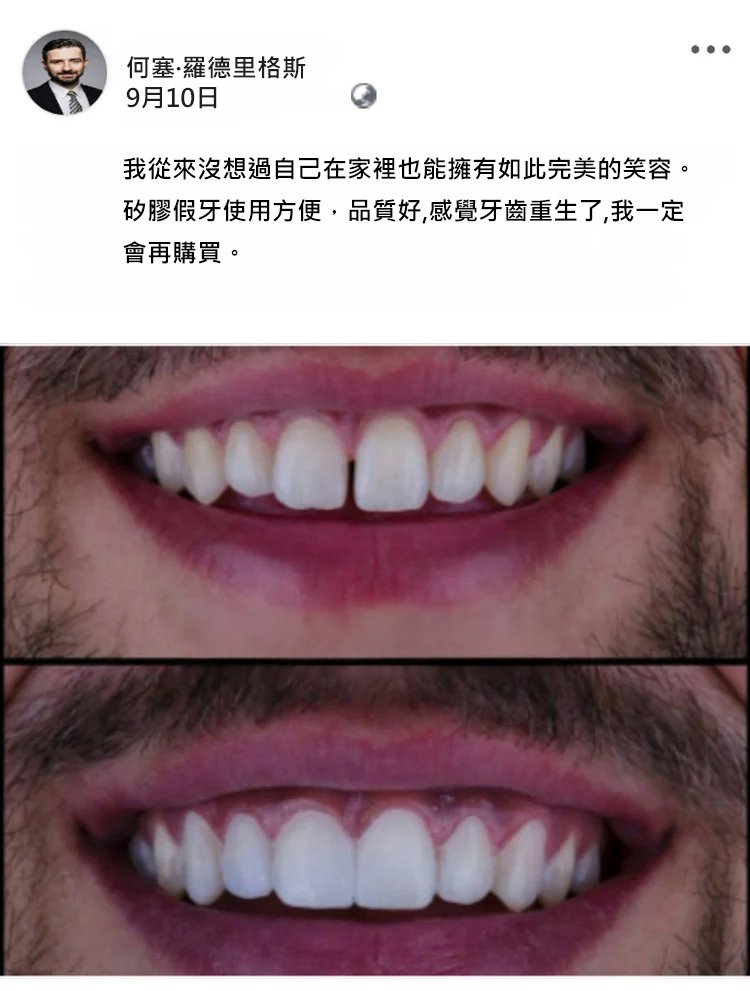 矽膠假牙套
