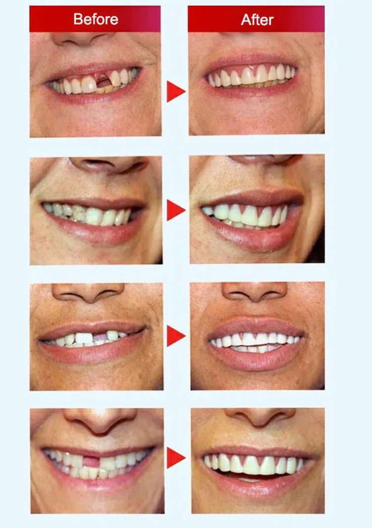 b67c351cf649b78425a2b437850e09dd MOON SMAIL Cosmetic dentures