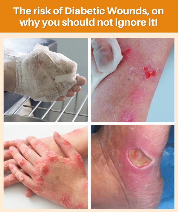 LOVILDS™Diabetic Wound Treatment Cream