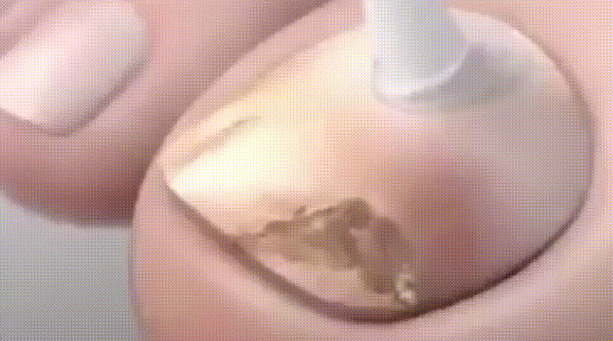 康速達灰指甲醫用退熱凝膠,,一個月手足灰甲全搞定,康束達凝膠5g每盒現貨速發 22 e1d6e0b81d8755528ba034f62fe093d3 康速達灰指甲醫用退熱凝膠