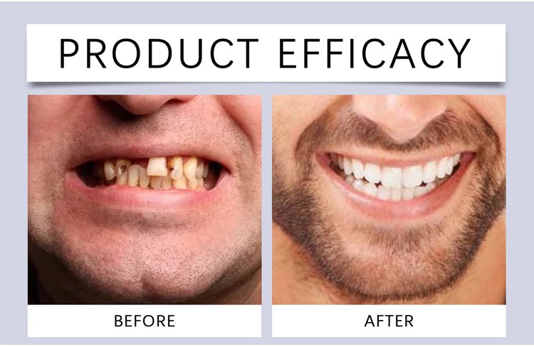 7b4d5c64c414e13ce0d30c99570570cf MOON SMAIL Cosmetic dentures