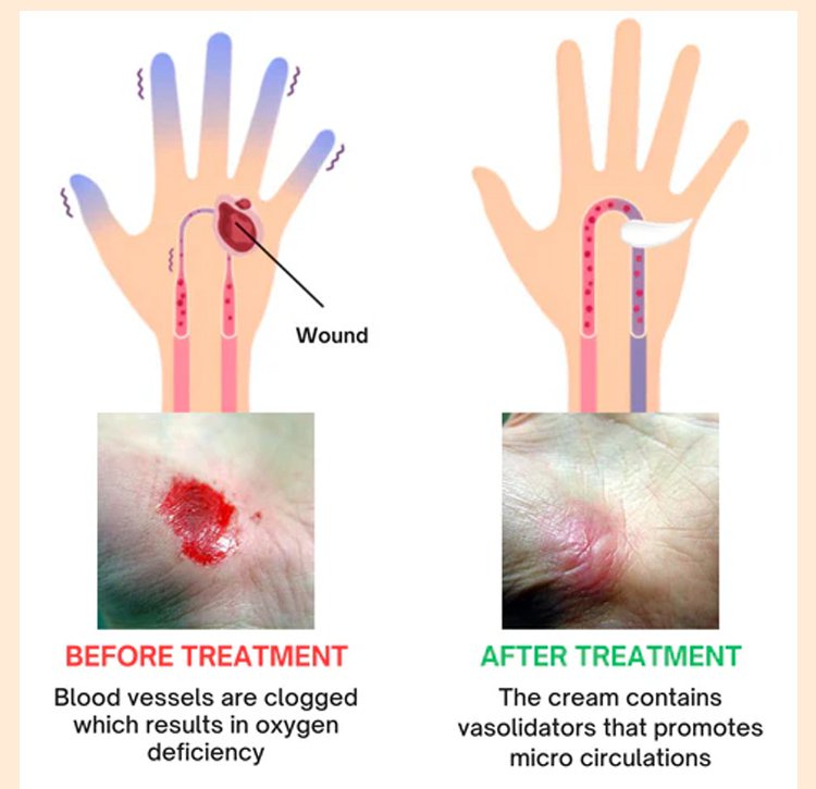LOVILDS™Diabetic Wound Treatment Cream