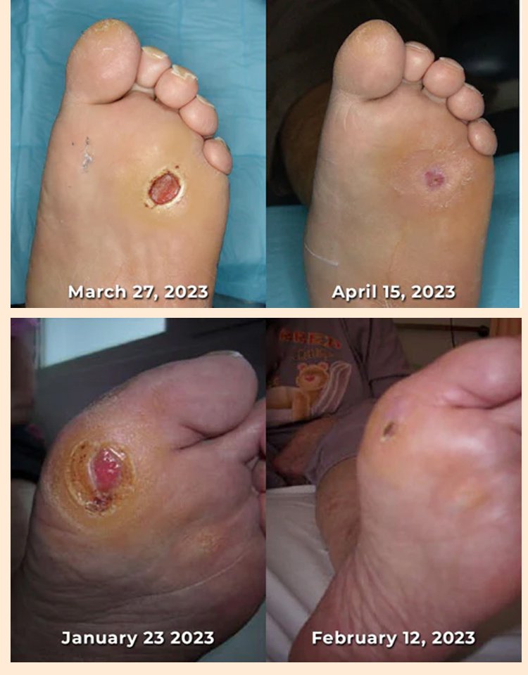 LOVILDS™Diabetic Wound Treatment Cream