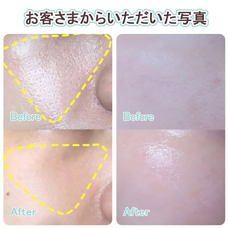 毛穴吸引器 Toobillオンラインストア