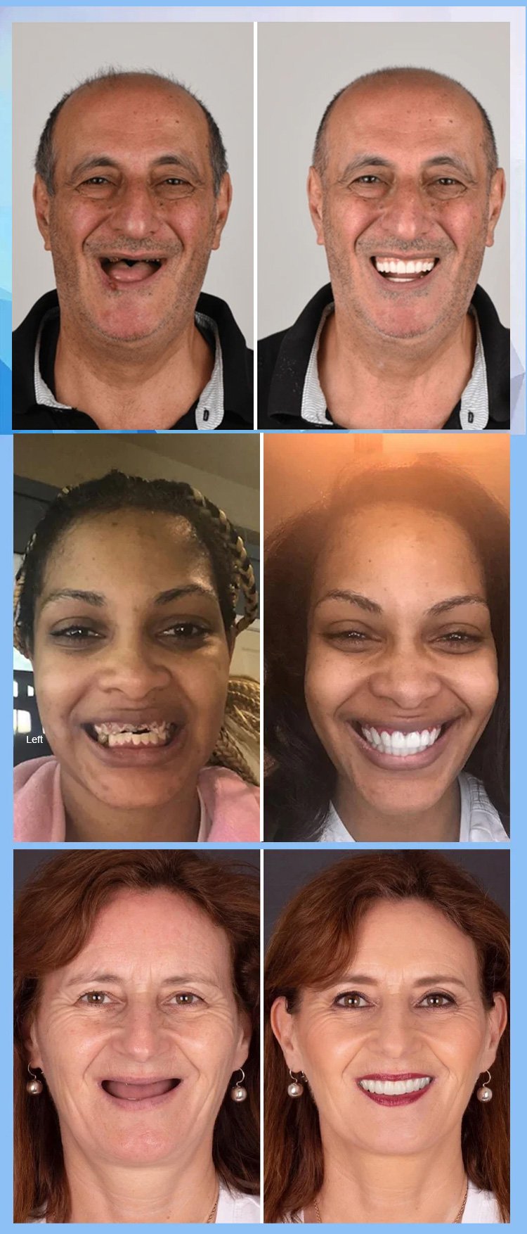 Yagoo™ Medical Full Denture image Yagoo™ Medical Full Denture