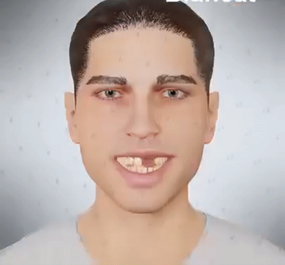 Yagoo™ Medical Full Denture