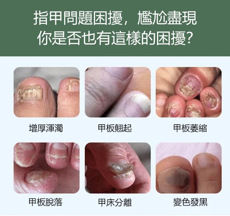 kinbt灰指甲膏1640249253613628.jpg 1640249253613628 kinbt灰指甲膏