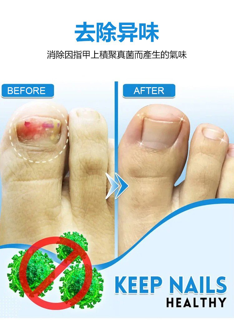 kinbt灰指甲膏1640249260943214.jpg 1640249260943214 kinbt灰指甲膏