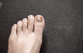kinbt灰指甲膏1640249596445591.gif 6.gif