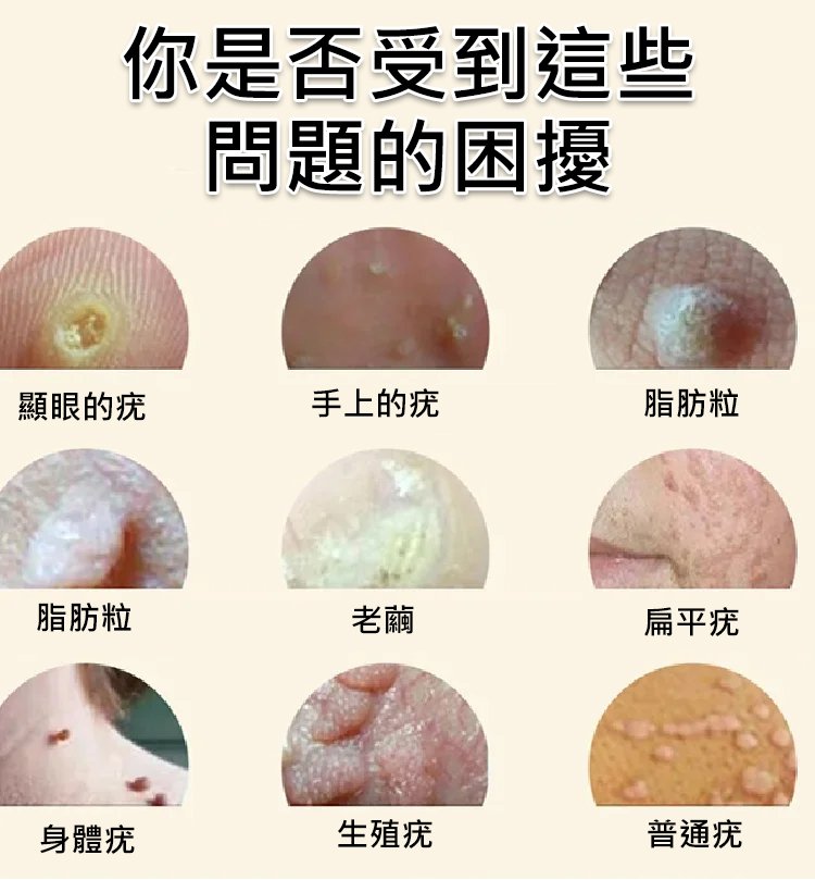 點痣克疣精華液 Dvkbc
