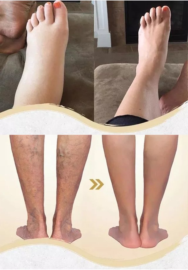 Varicose Veins Edema Care Socks