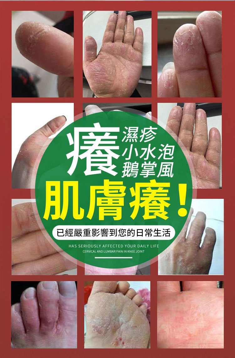 South Moon手蘚腳氣噴霧 6 18cfaf2dcd24b3e426f3aa4c0cb68647 South Moon手蘚腳氣噴霧