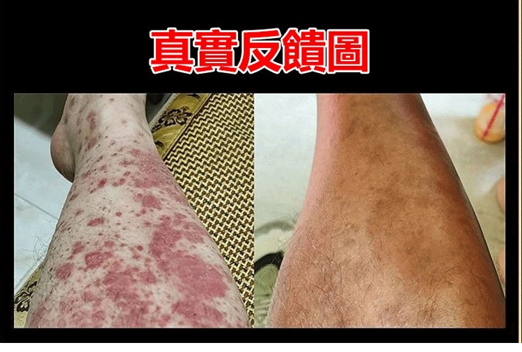 頑毒淨乳膏頑達康日本配方 9 24682190265529b56d62e7004844861f 頑毒淨乳膏頑達康日本配方