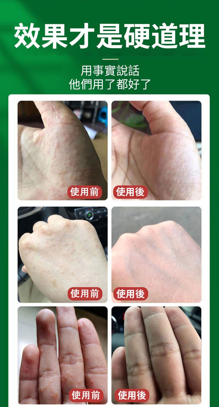South Moon手蘚腳氣噴霧 18 2a9d051995ccb585fe9d2a077af310b9 South Moon手蘚腳氣噴霧