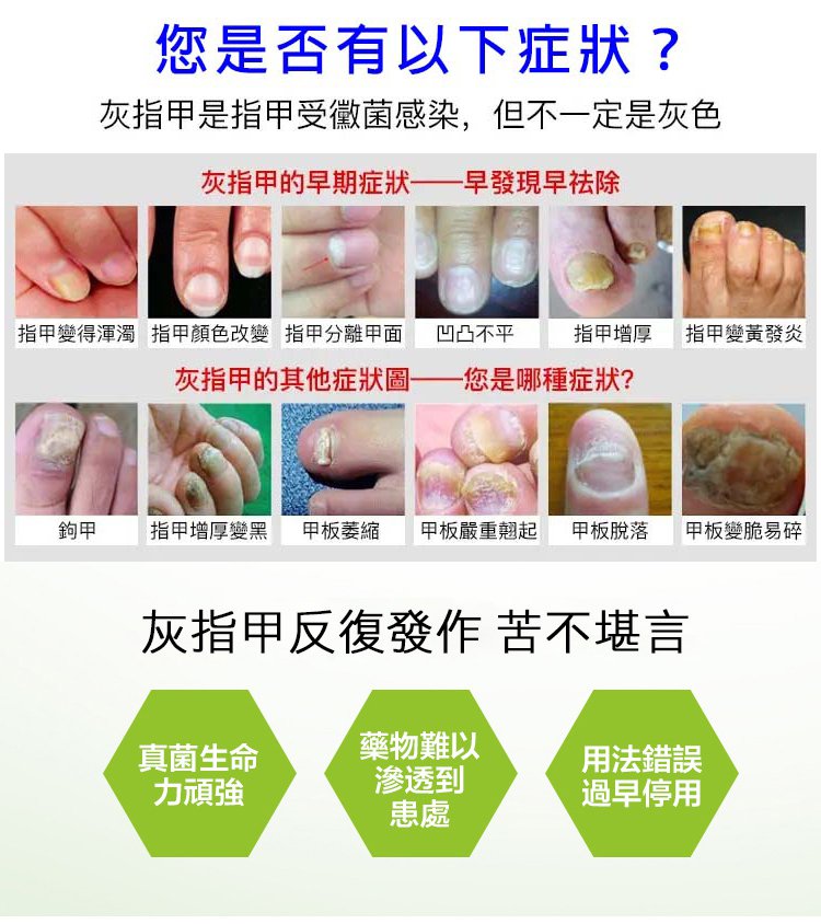 kinbt灰指甲膏 kinbt灰指甲膏