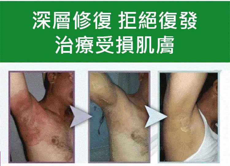 South Moon手蘚腳氣噴霧 26 847fa59cd7114e166fe02b419848c9cd South Moon手蘚腳氣噴霧