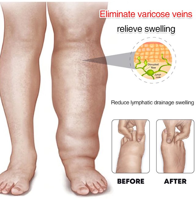 Varicose Veins Edema Care Socks