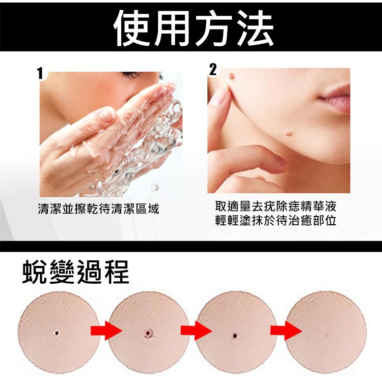 點痣克疣精華液 Dvkbc