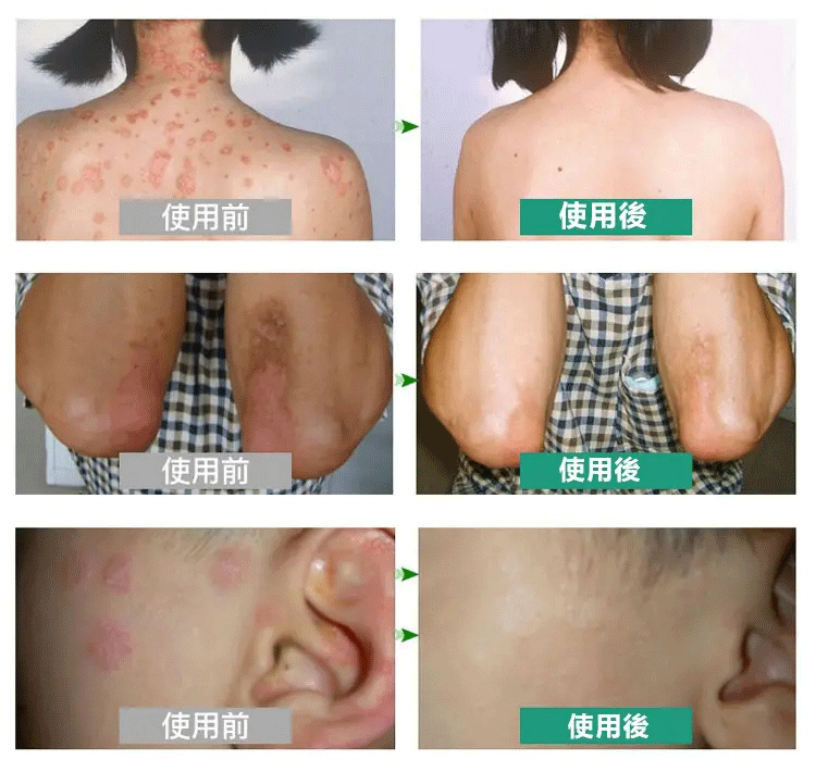 頑毒淨乳膏頑達康日本配方 17 b2dc459387a4a4809caa1e2c6e3bec8f 頑毒淨乳膏頑達康日本配方