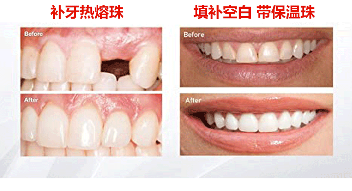 可塑性牙膠 13 e22e99130e0fc413eb807f84f860fdee 可塑性牙膠