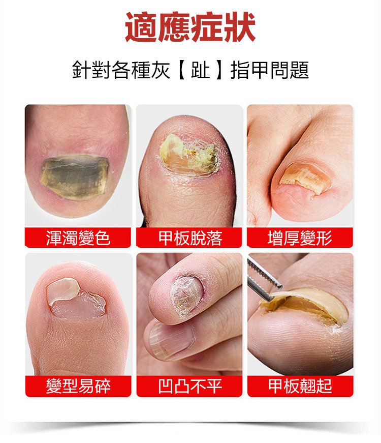 kinbt灰指甲膏 kinbt灰指甲膏