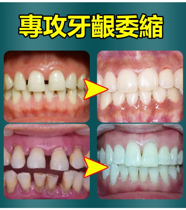 牙齒晃動牙膏 13 f2972b9c0483023496486f6cc41d7346 牙齒晃動牙膏